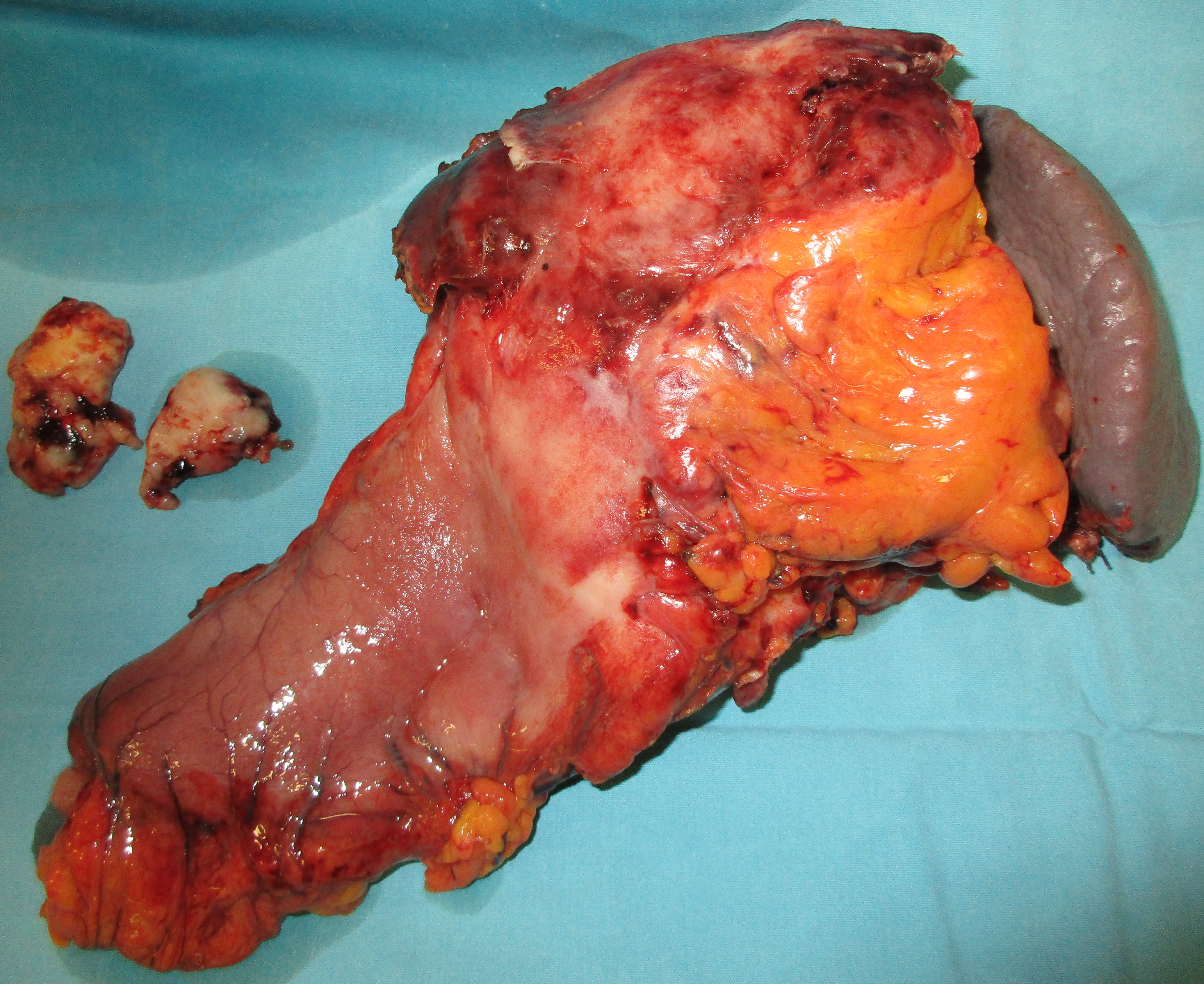 GASTRIC LYMPHOMA