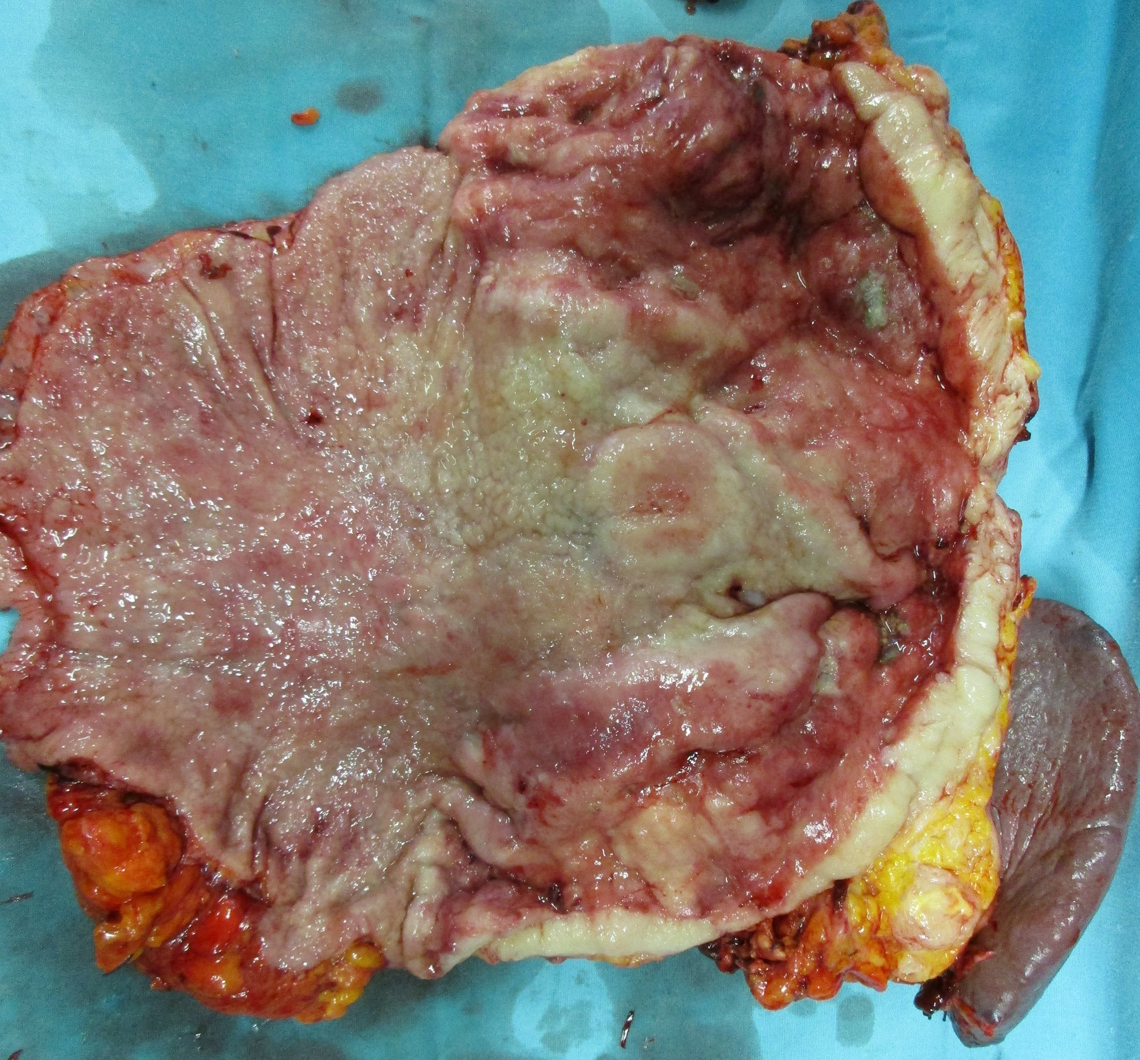 GASTRIC LYMPHOMA