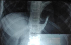 GASTRIC VOLVULUS