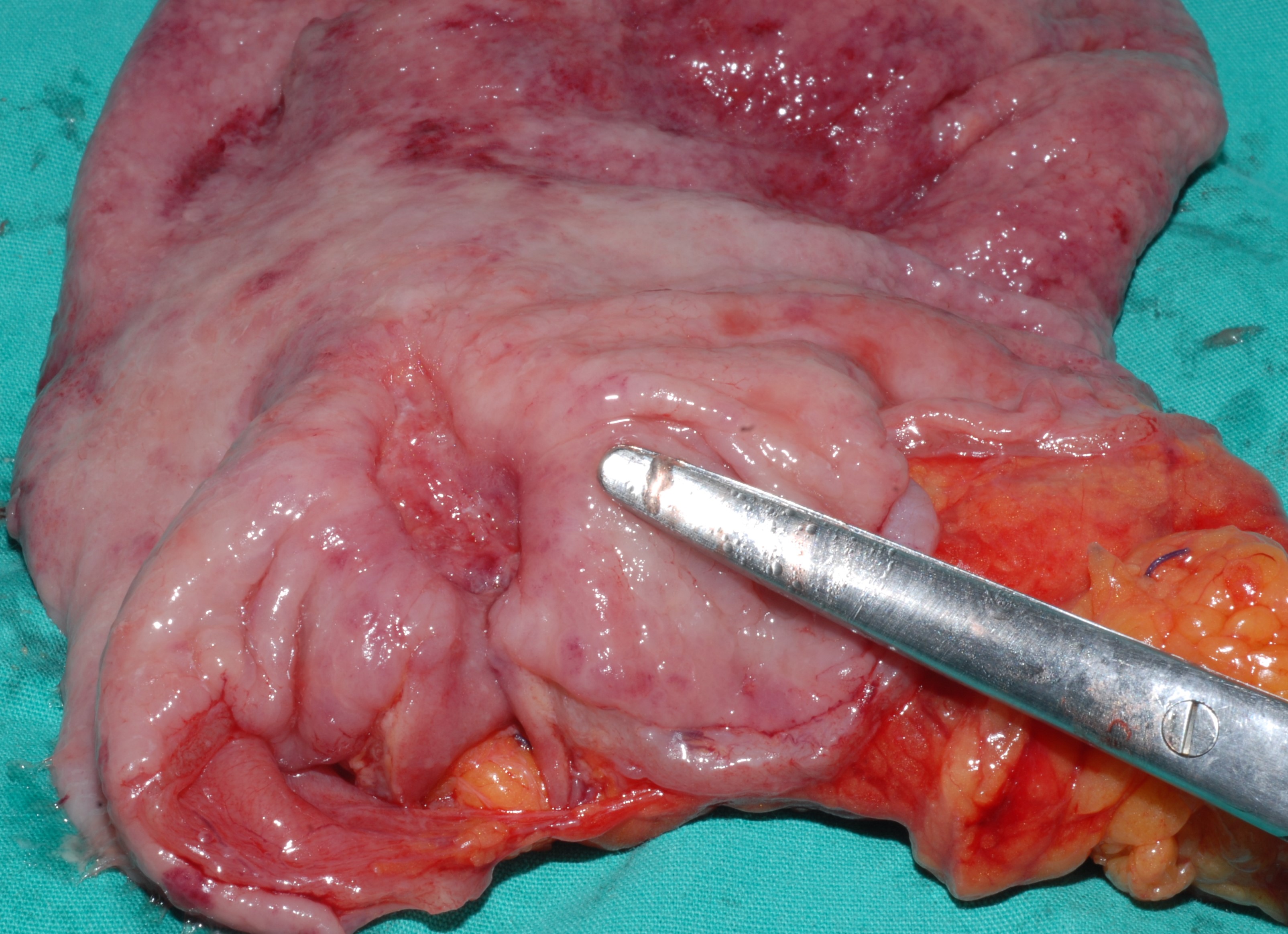 ULCERATIVE GASTRIC CANCER