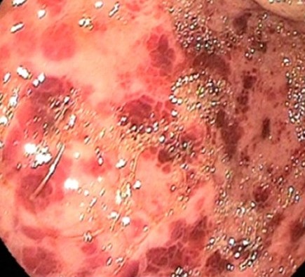 HEMORRHAGIC GASTRITIS