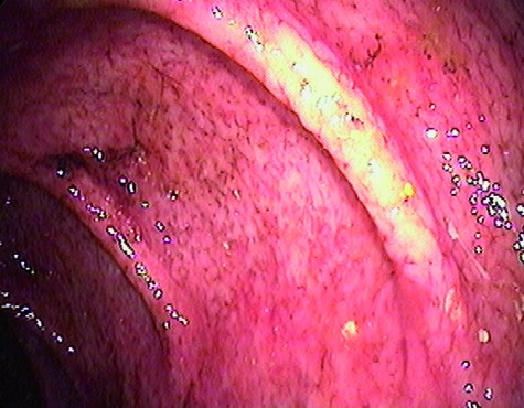 EOSINOPHILIC GASTRITIS