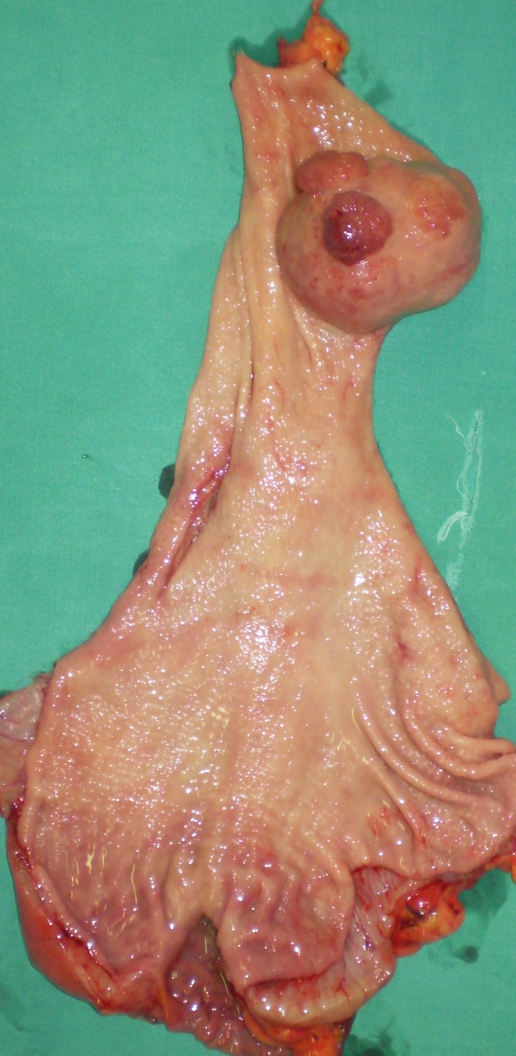 GASTRIC GIST