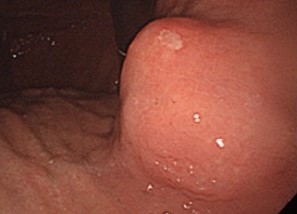 GASTRIC GIST