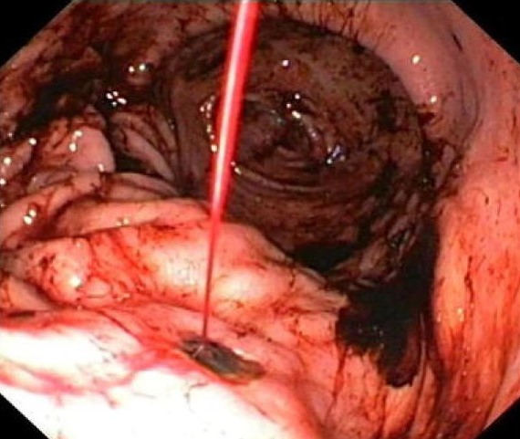 BLEEDING GASTRIC ULCER
