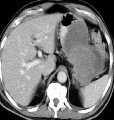 SPONTANEOUS GASTRIC GIST RUPTURE