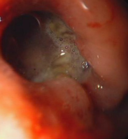 SPONTANEOUS GASTRIC GIST RUPTURE