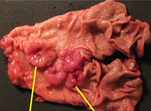 SYNCHRONOUS GASTRIC CARCINOMAS