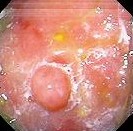 ADENOMATOUS GASTRIC POLYP
