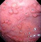 ADENOMATOUS GASTRIC POLYP