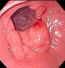 ADENOMATOUS GASTRIC POLYP