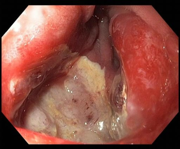 ANASTOMOTIC ULCER - GASTRIC BYPASS 