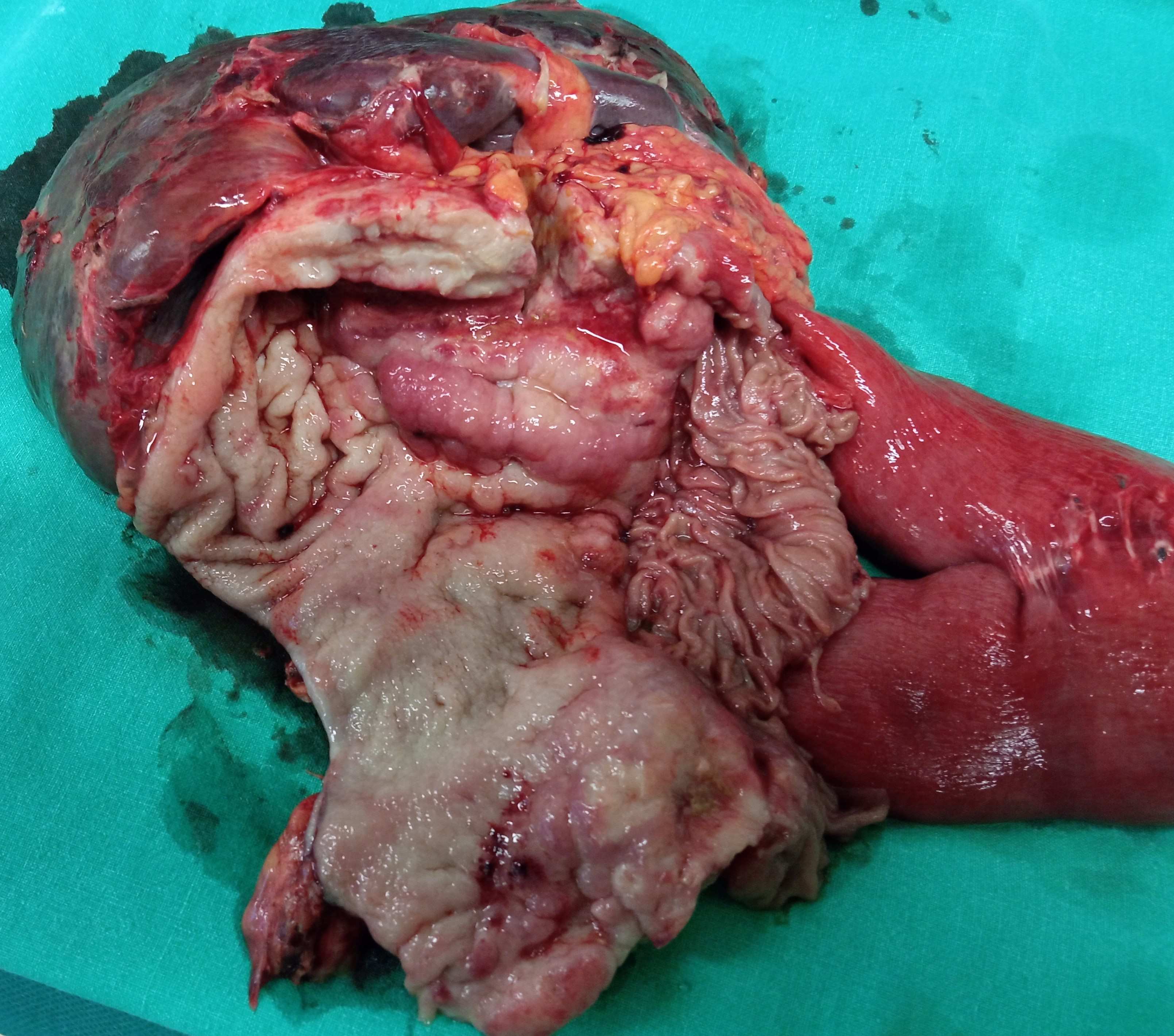 ANASTOMOTIC GASTRIC CANCER