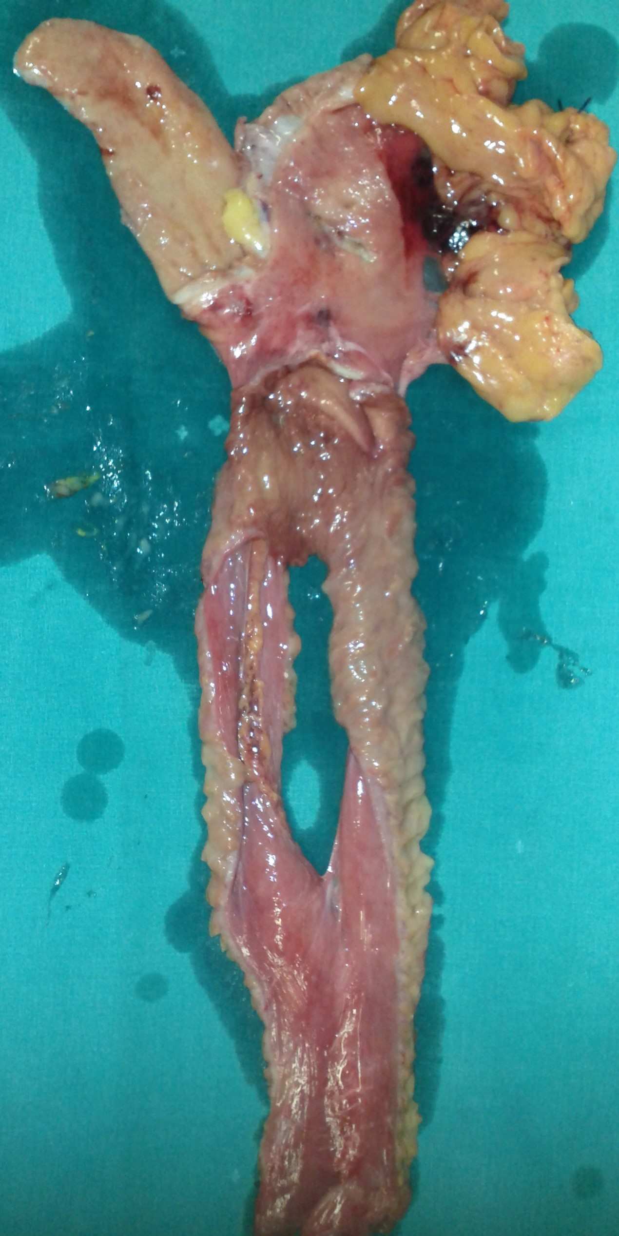 ANASTOMOTIC GASTRIC CANCER