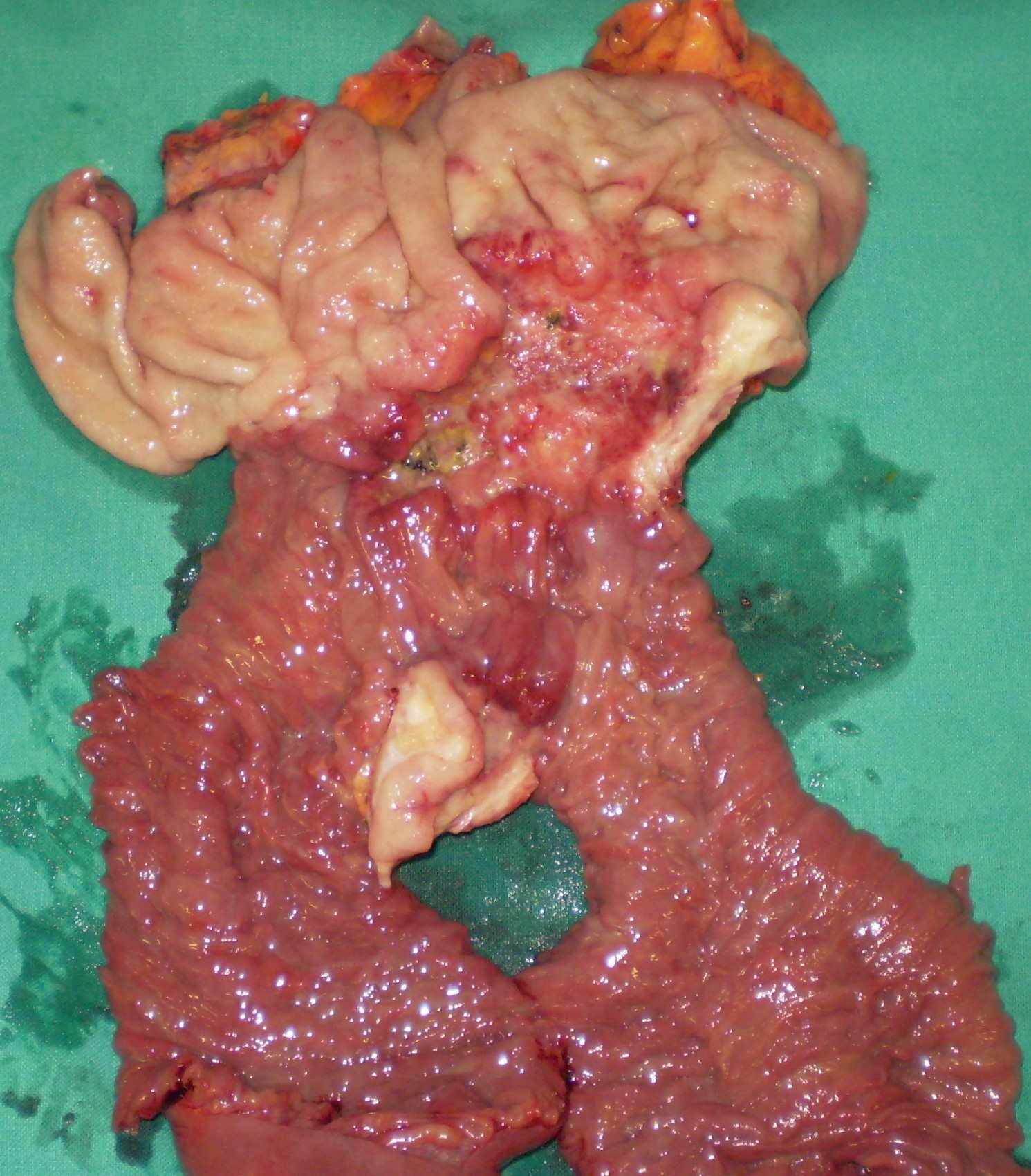 ANASTOMOTIC GASTRIC CANCER