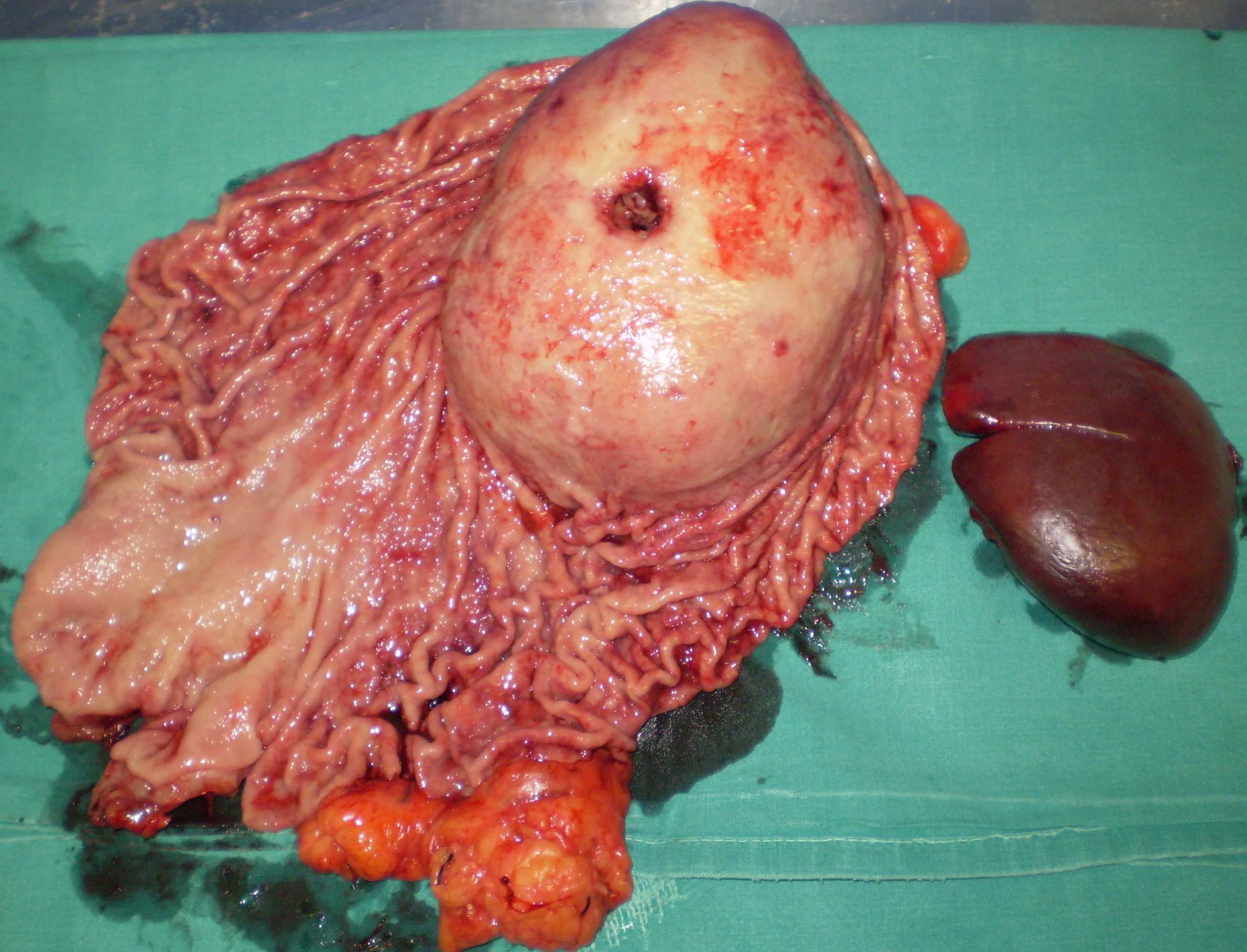 BLEEDING GASTRIC MALIGNANT GIST