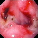 BLEEDING GASTRIC ULCER