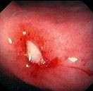 BLEEDING GASTRIC ULCER