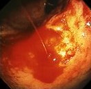 BLEEDING GASTRIC ULCER