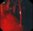 BLEEDING MARGINAL ULCER