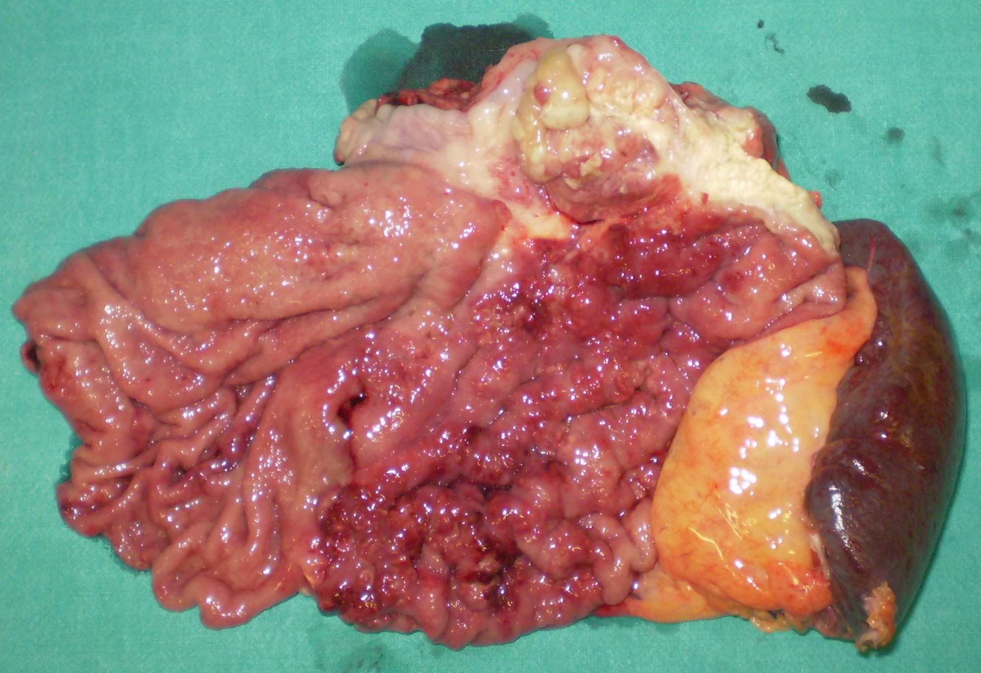 PROXIMAL GASTRECTOMY