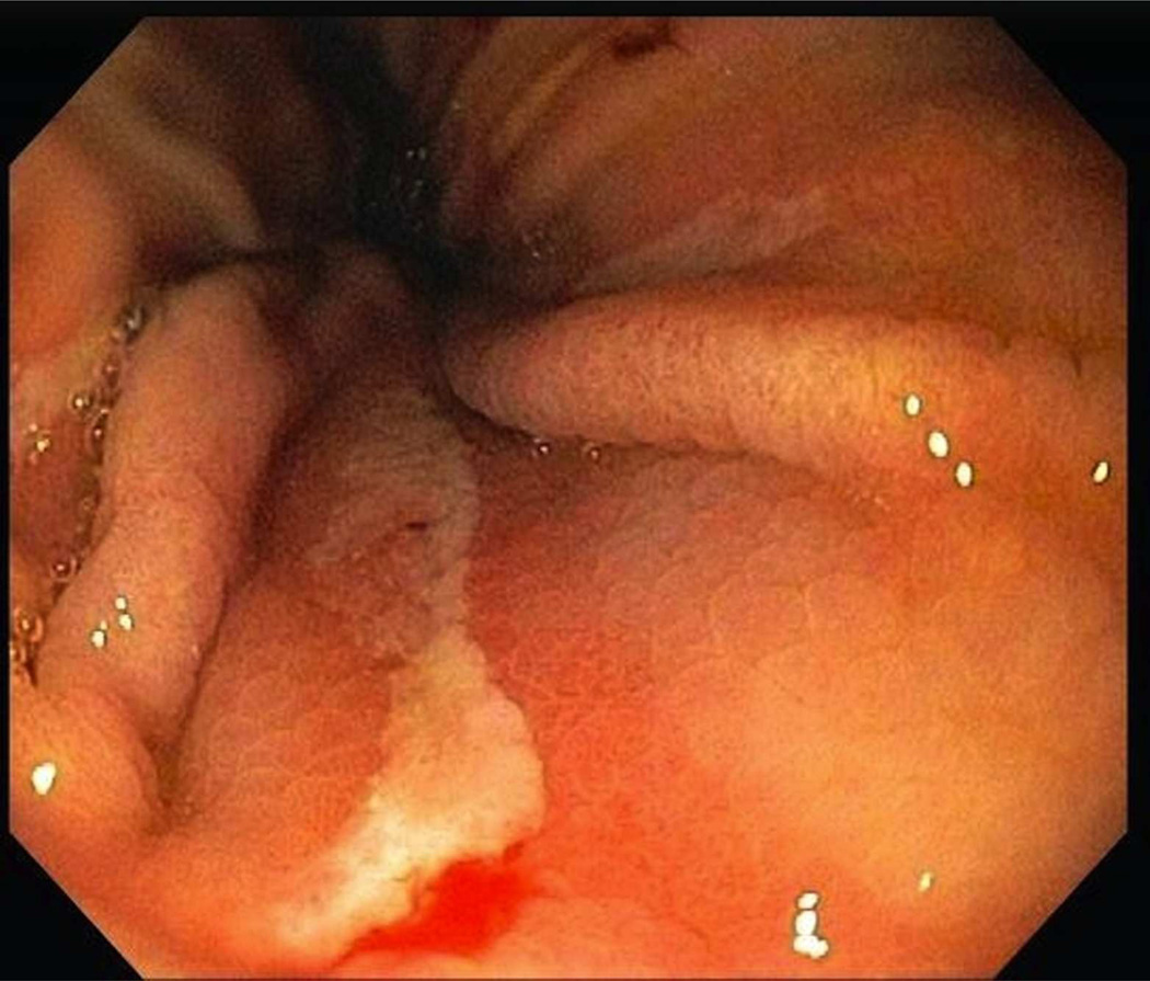 CAMERON ULCER