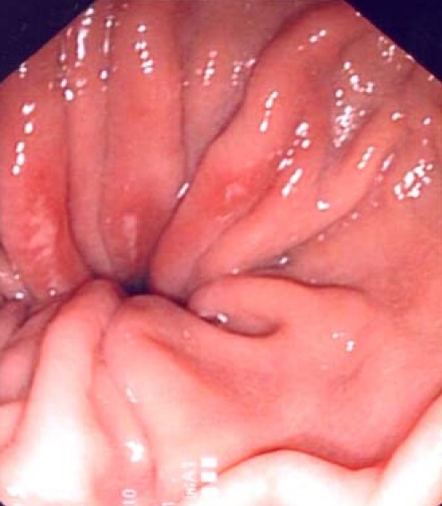 CAMERON ULCER