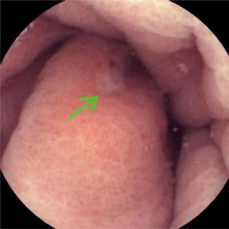 CAMERON ULCER