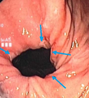 CAMERON ULCER