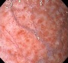 CHRONIC DIFFUSE GASTRITIS