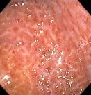 CHRONIC DIFFUSE GASTRITIS