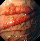 CMV GASTRITIS