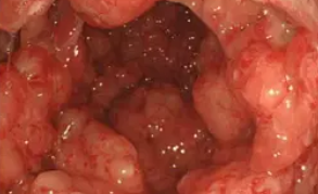 CRONKHITE CANADA SYNDROME