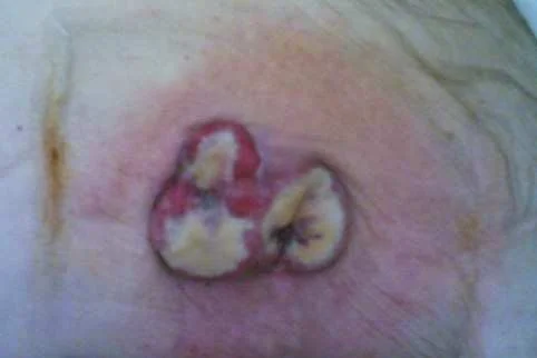 DRAIN SITE METASTASIS - GASTRIC CARCINOMA