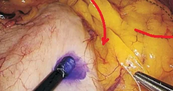 EARLY GASTRIC CARCINOMA