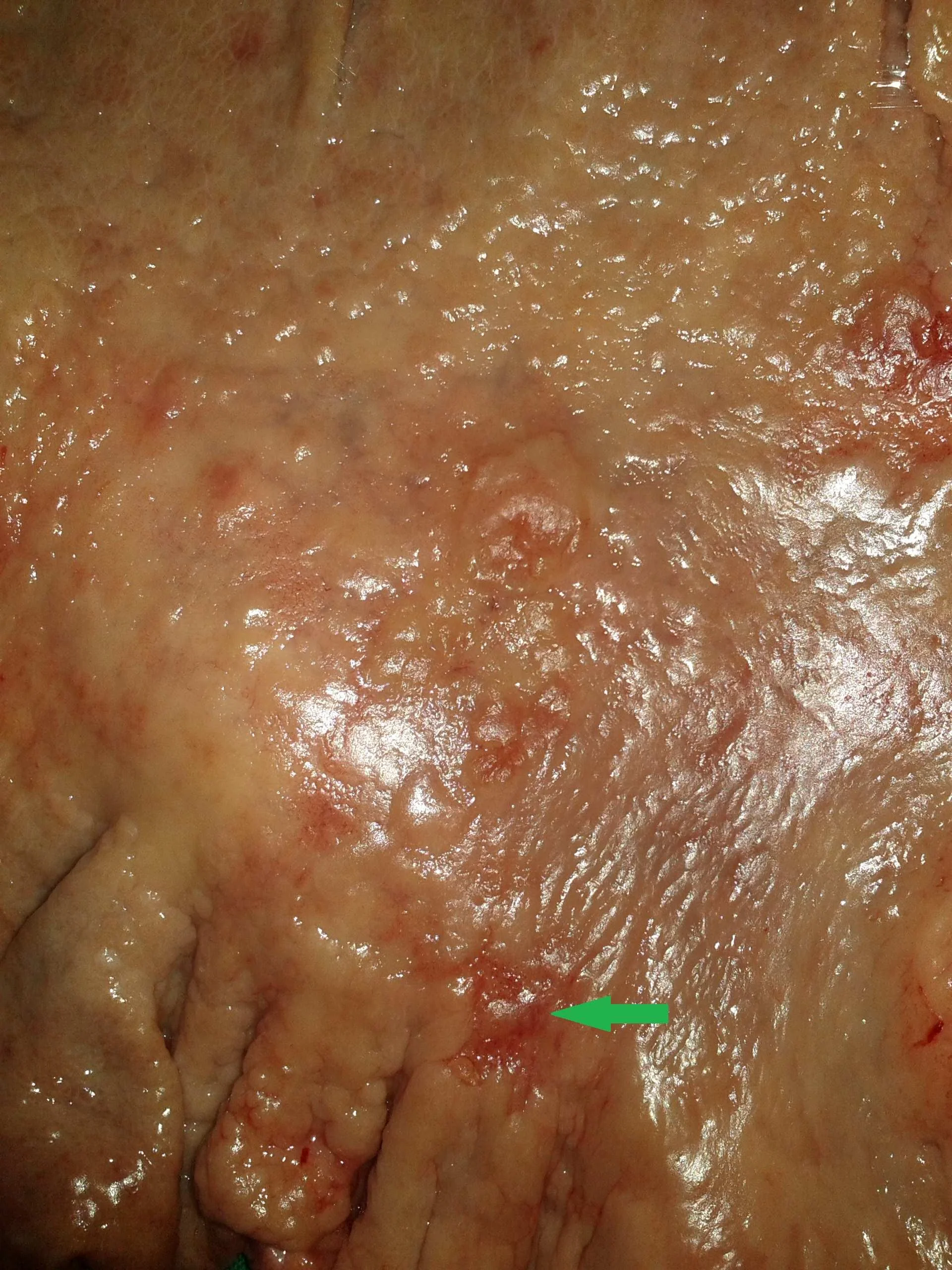 EARLY GASTRIC CARCINOMA