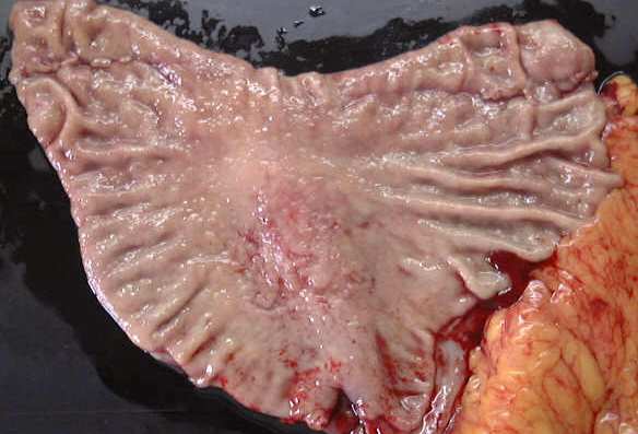 EARLY GASTRIC CARCINOMA
