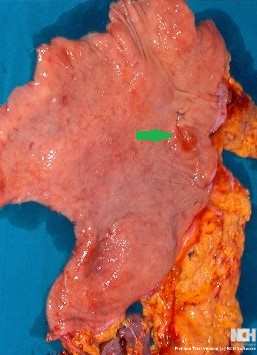 EARLY GASTRIC CARCINOMA