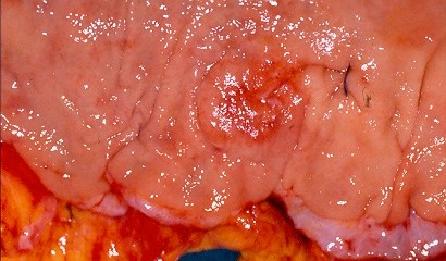 EARLY GASTRIC CARCINOMA