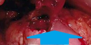 ECTOPIC GASTRIC PANCREAS - PERFORATION