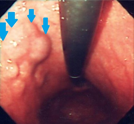 ECTOPIC GASTRIC PANCREAS