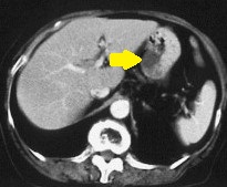 ECTOPIC GASTRIC PANCREAS
