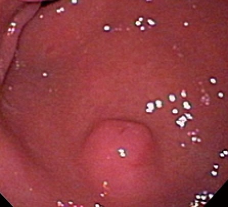 ECTOPIC GASTRIC PANCREAS