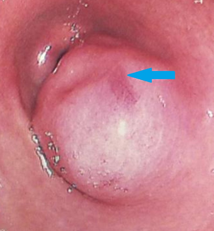 ECTOPIC GASTRIC PANCREAS