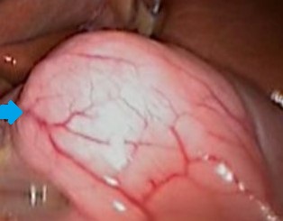 ECTOPIC GASTRIC PANCREAS