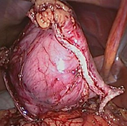 ECTOPIC GASTRIC PANCREAS