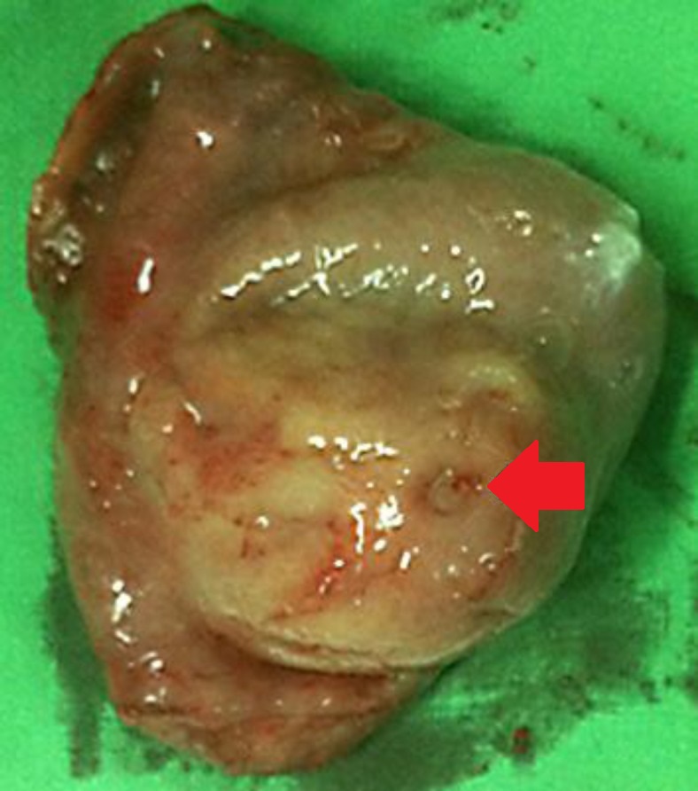 ECTOPIC GASTRIC PANCREAS
