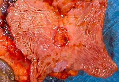 ULCERATED GASTRIC CANCER