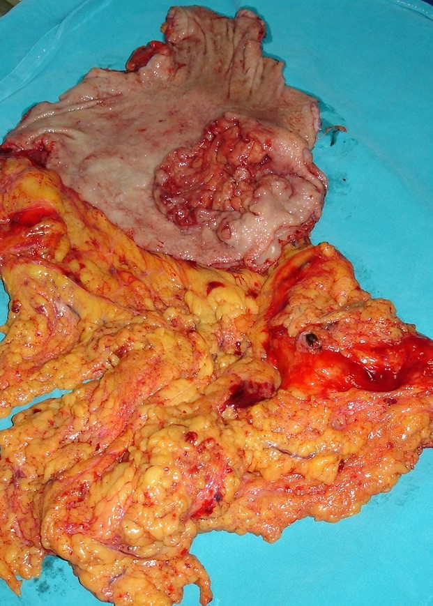 ULCERATED GASTRIC CANCER