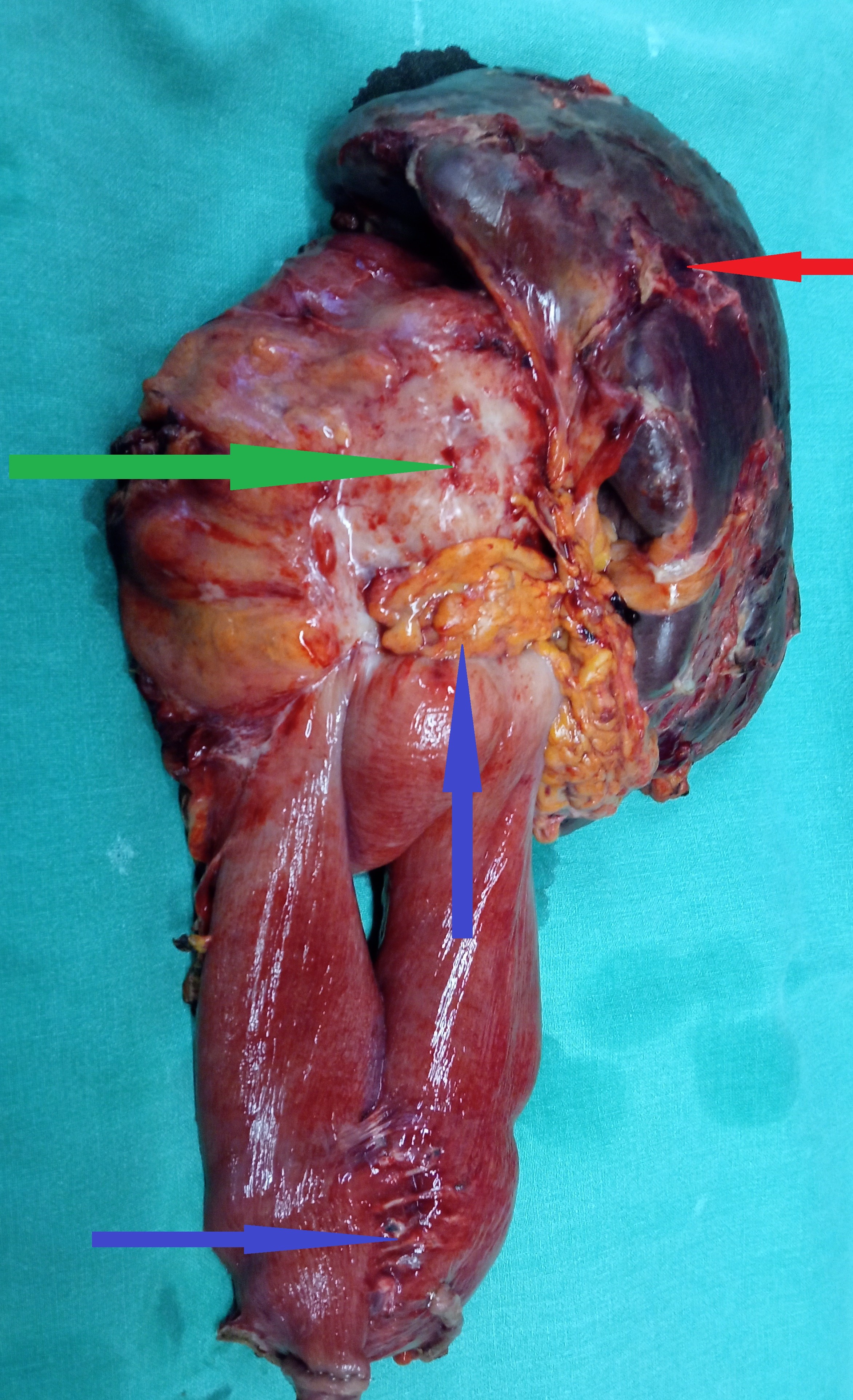 ANASTOMOTIC GASTRIC CANCER - EN BLOC EXCISION